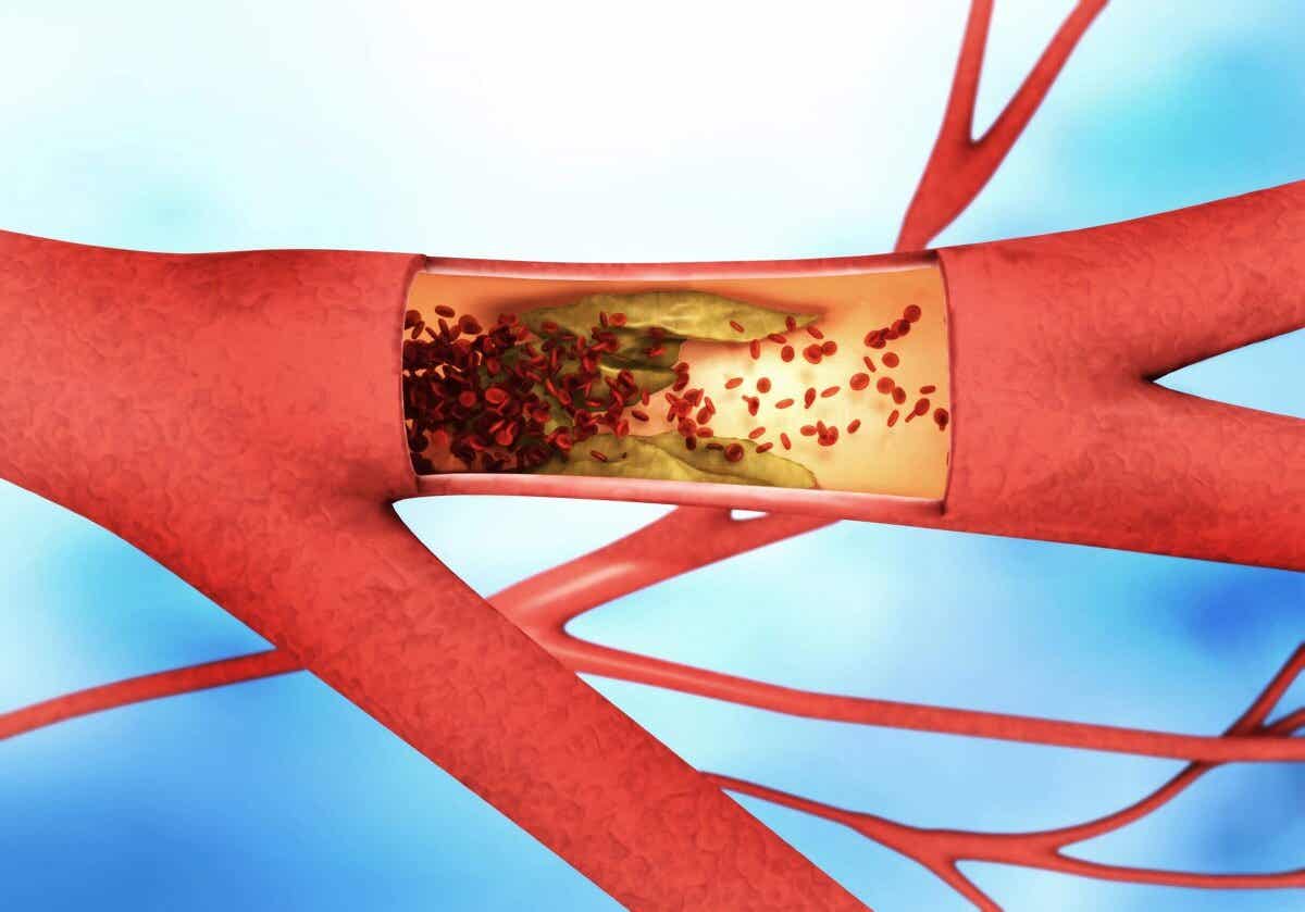 Запушване на артерии - използване на наргиле
