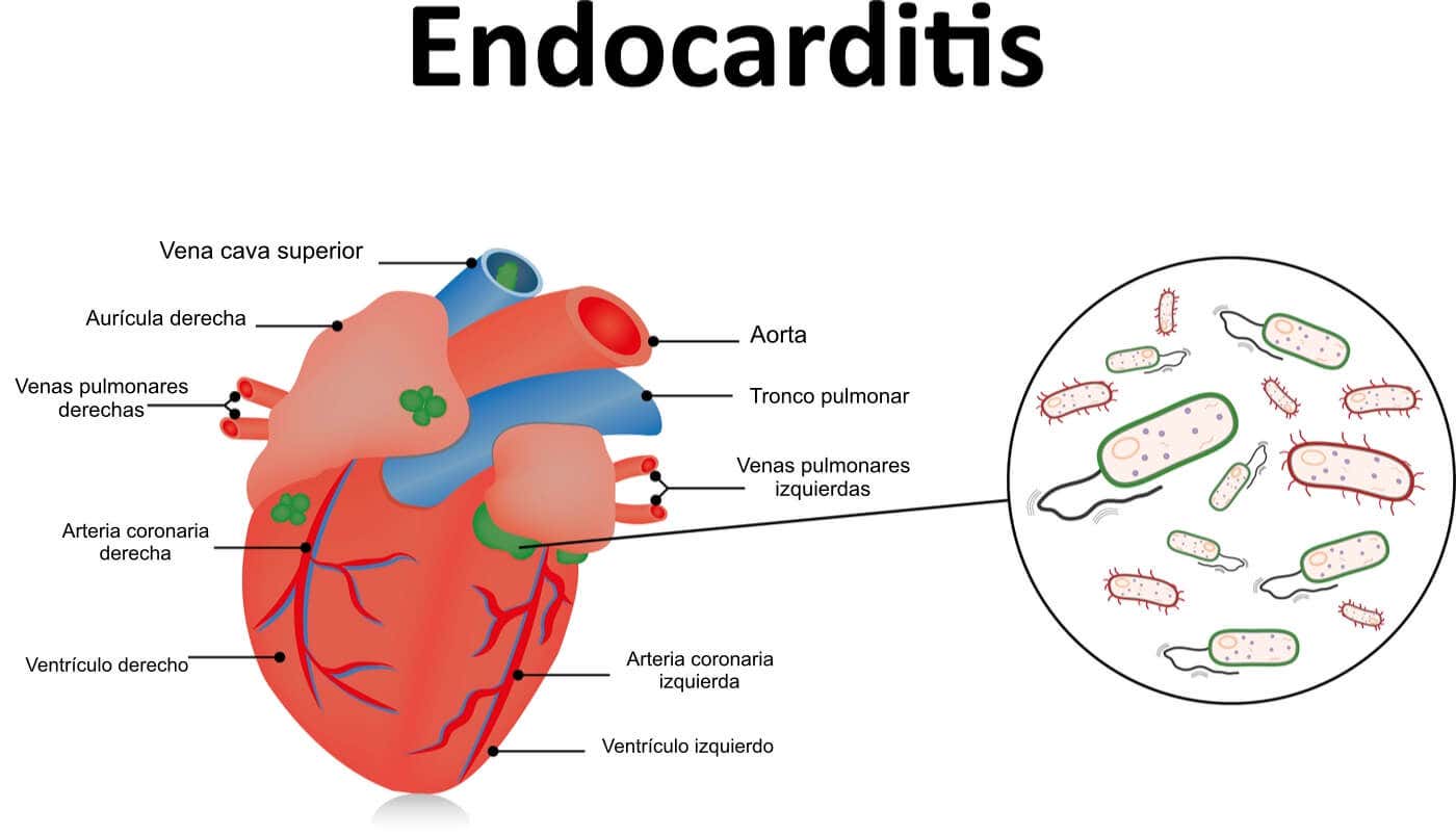 Endocarditis: una infección en el corazón
