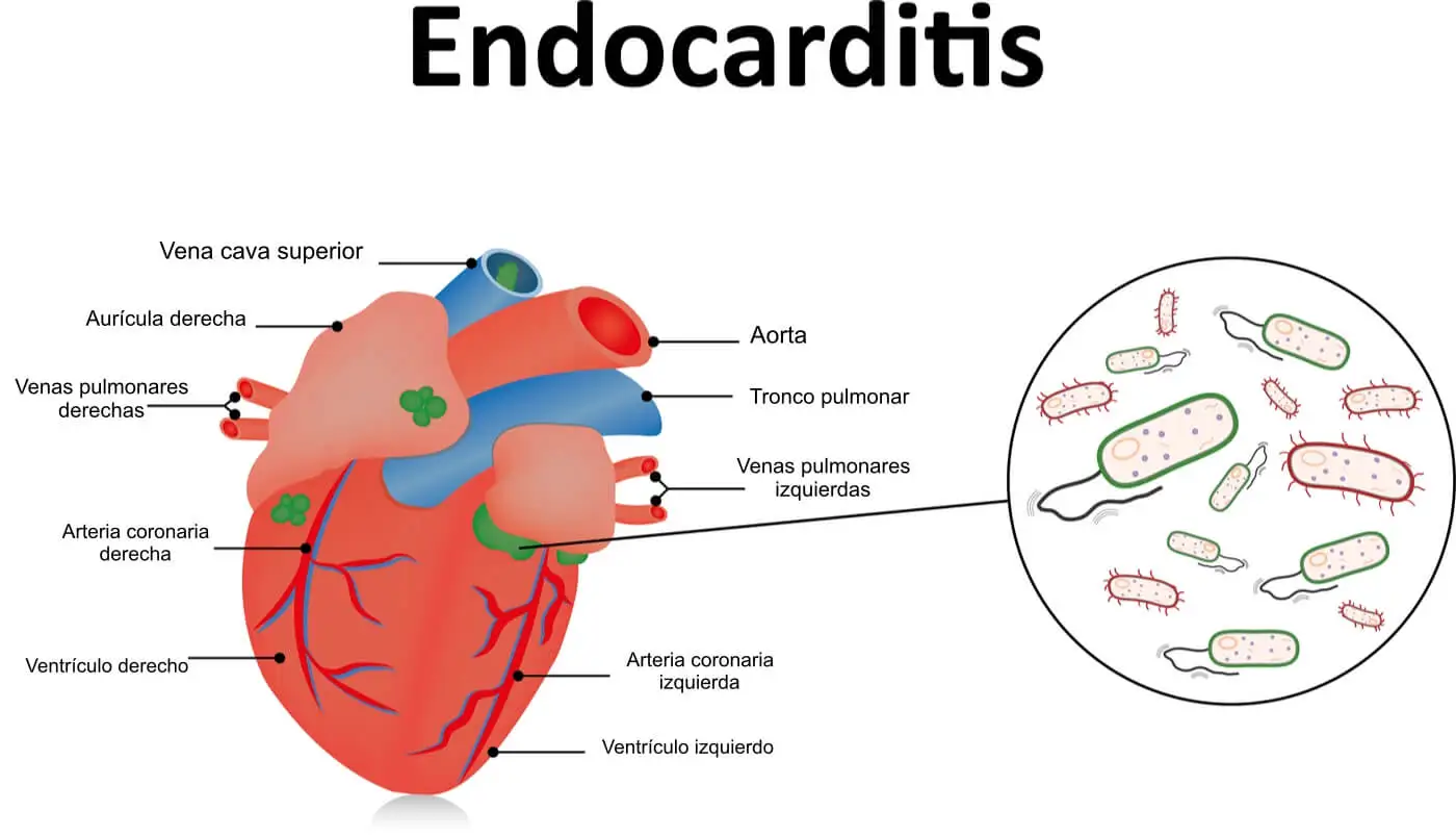 Endocarditis: una infección en el corazón