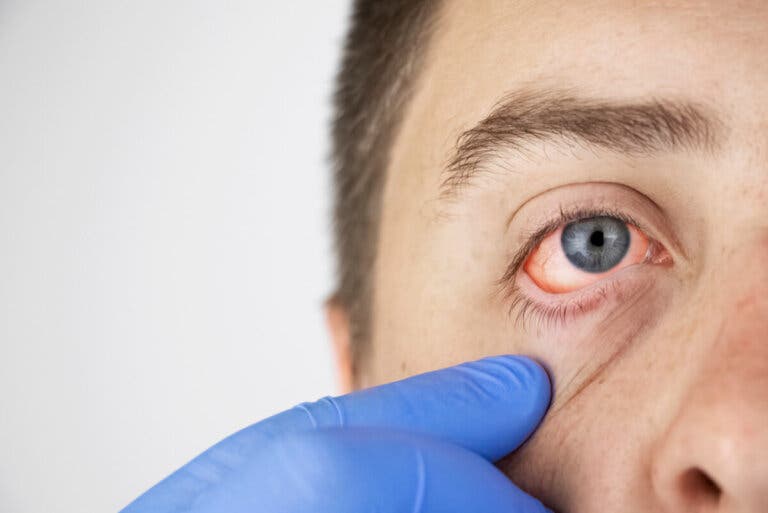 Haemolacria: llorar sangre es real