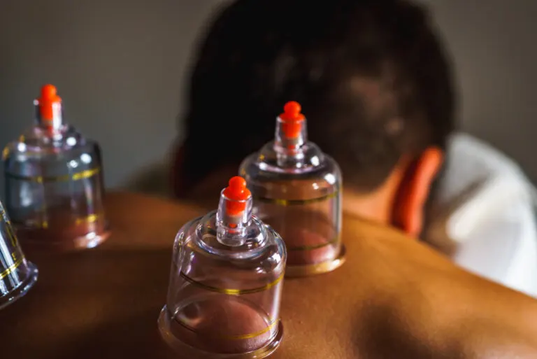 Cupping o masaje con ventosas: ¿en qué consiste?