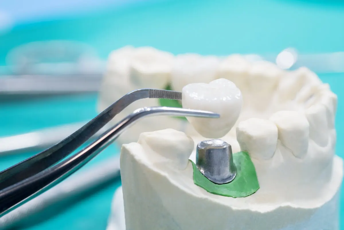 Implant dentystyczny