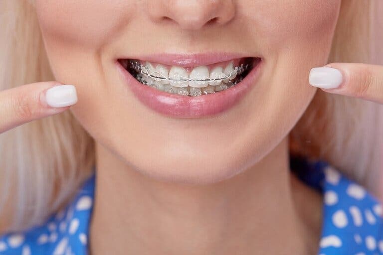 Brackets de cerámica: ¿qué debo saber?
