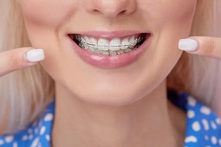 Brackets de cerámica: ¿qué debo saber?