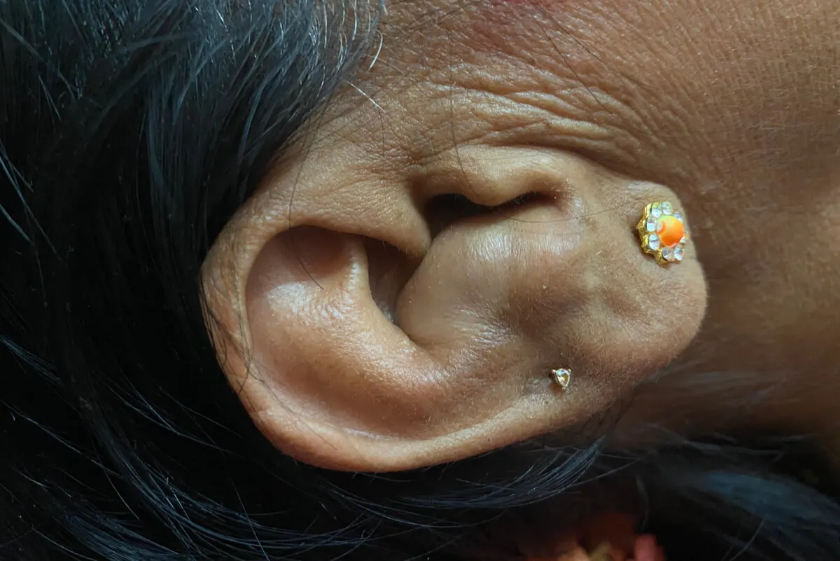 Paciente con oreja de coliflor.