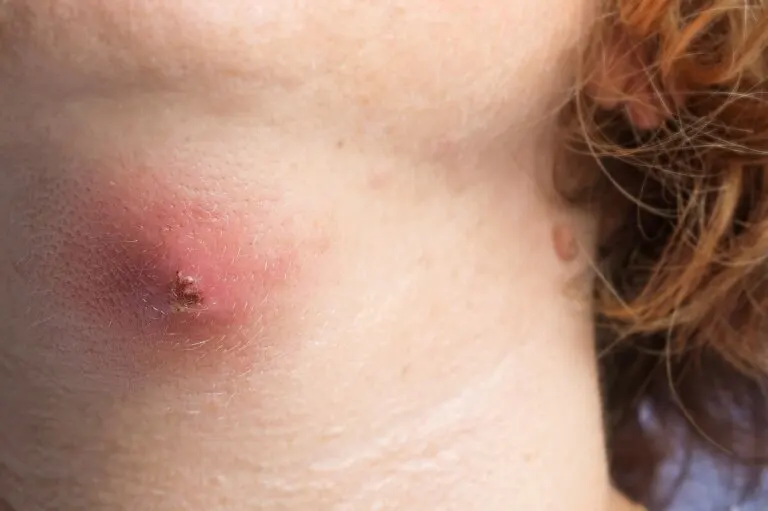 Celulitis infecciosa: causas y tratamiento