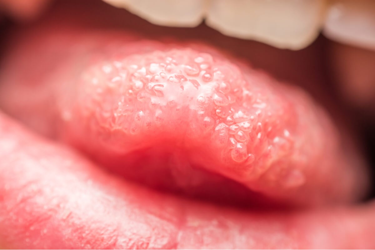 Πικρή αίσθηση στο στόμα ή δυσγευσία: Τι μπορεί να την προκαλέσει;