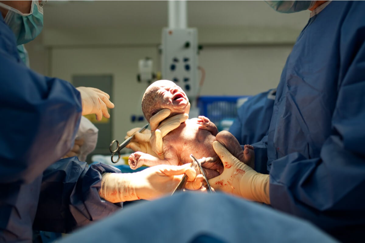 Postpartale AnÃ¤mie - neugeborenes Baby nach Kaiserschnitt
