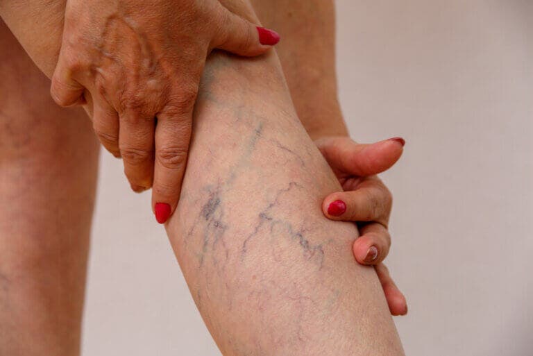 Flebitis: qué es, síntomas y tratamiento