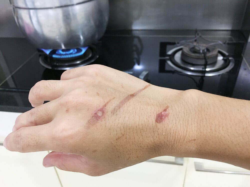 ¿Cómo ocurren las quemaduras con vapor y agua caliente?