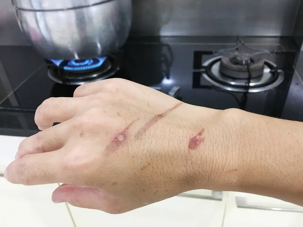 ¿Cómo ocurren las quemaduras con vapor y agua caliente?