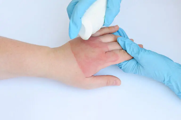Quemaduras con vapor y agua caliente: tratamientos y recomendaciones