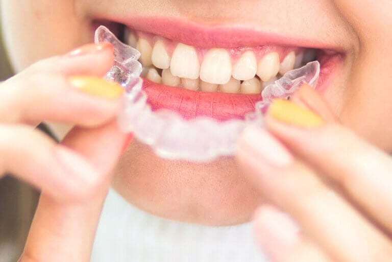 Retenedores dentales: ¿cuándo son necesarios?