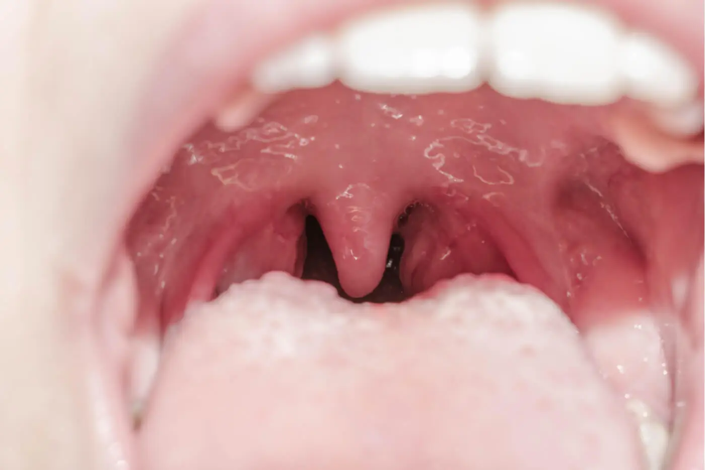 Uvulitis