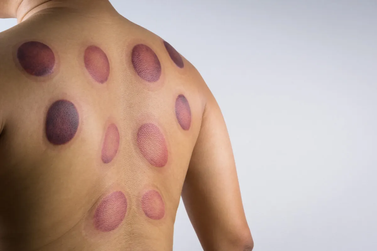 Blessures au dos dues aux ventouses.