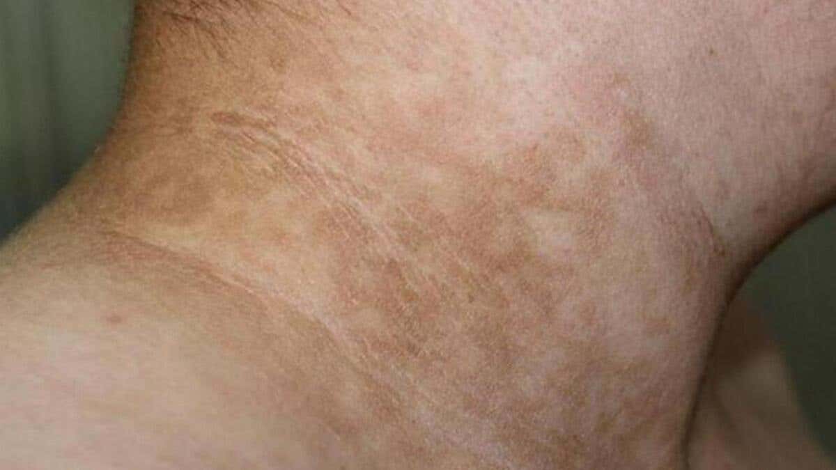 Acantosis nigricans es señal de diabtes en la piel.