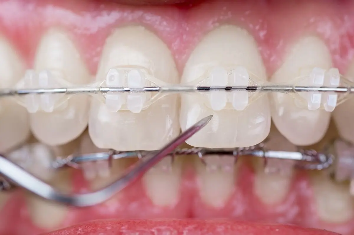 Brackets de cerámica.