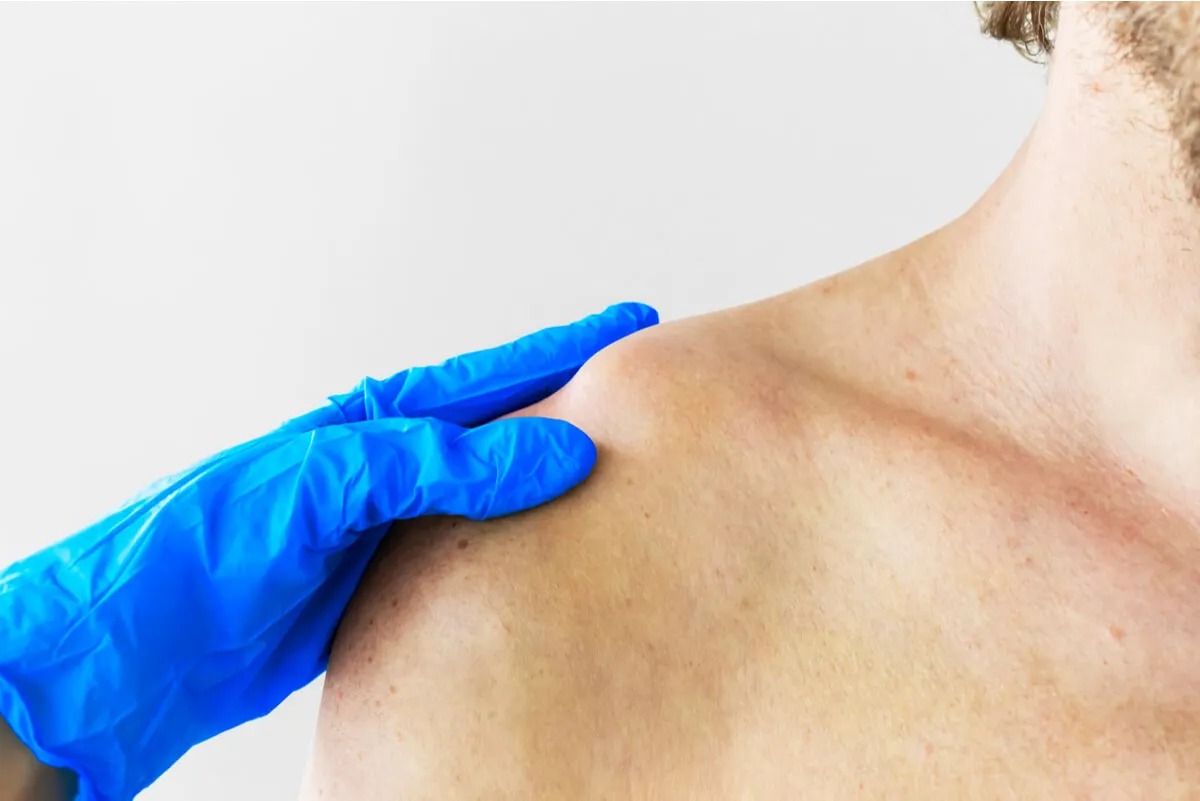 Bulto en el hombro por fractura de clavícula.