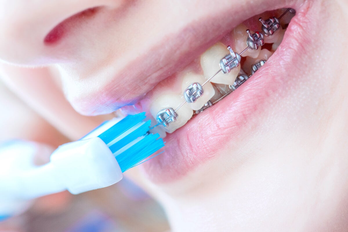 Cepillado de dientes para el cuidado de los brackets.