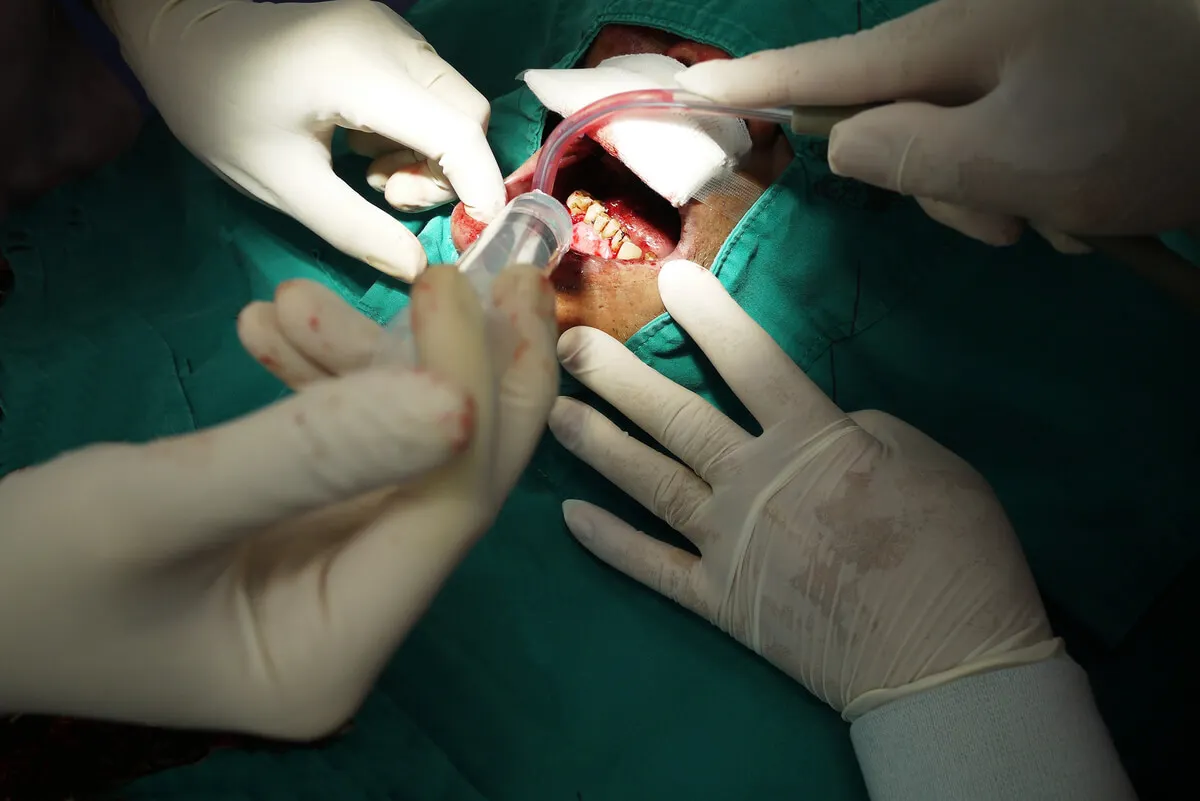 Cirugía para cáncer de boca.