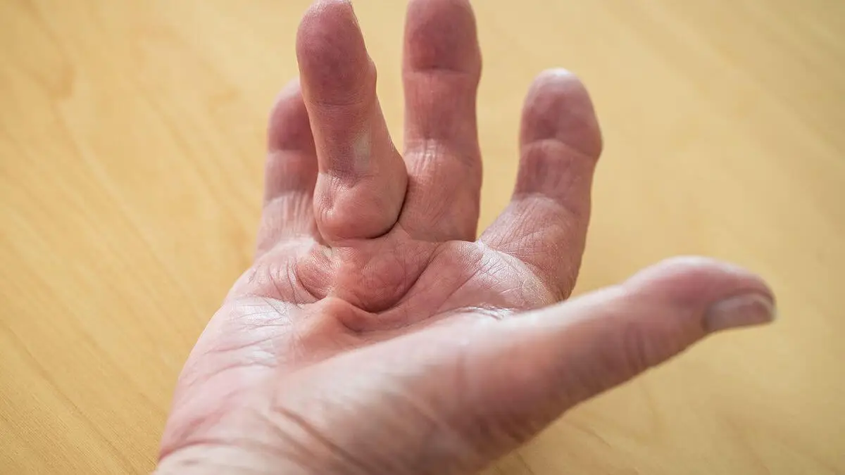 Contractura de Dupuytren.