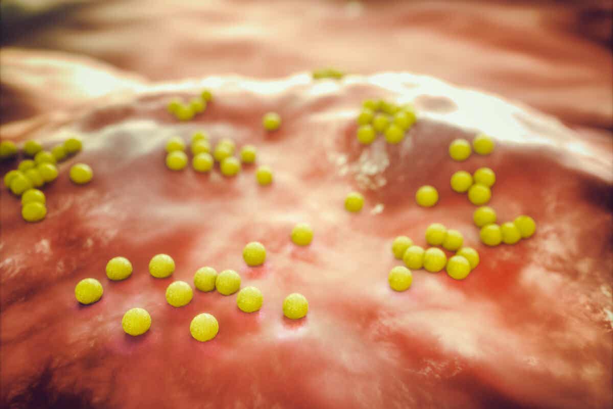 Organismos resistentes: infección por SARM