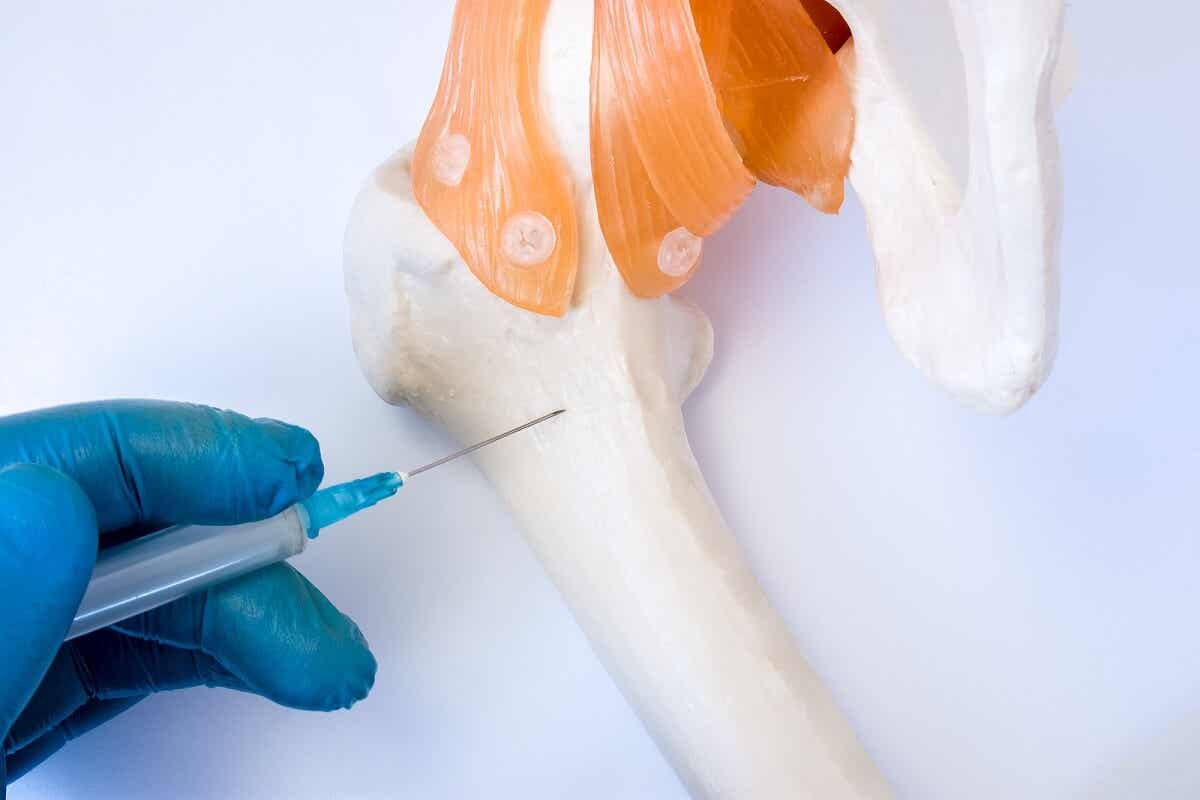 Aspiración y biopsia de médula ósea: ¿en qué consiste?