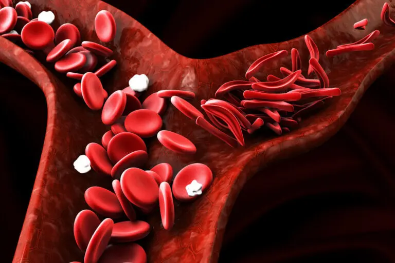 Esferocitosis hereditaria: síntomas, diagnóstico, tratamiento