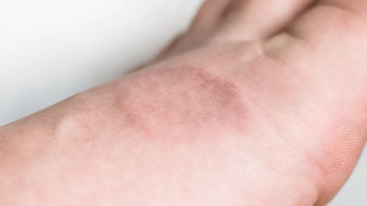 Granuloma anular en la diabetes.