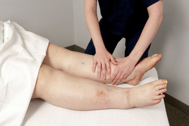 Edema linfático o linfedema: todo lo que debes saber