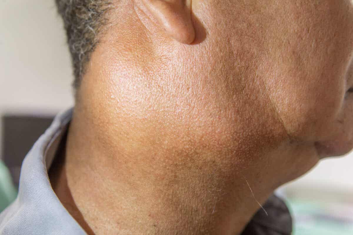 A lump in a man's neck