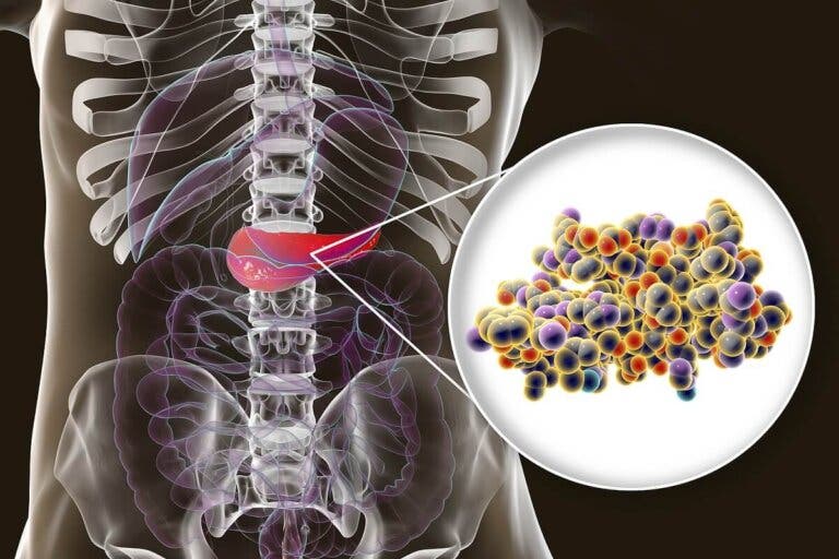 Insulinoma: causas, síntomas y tratamientos