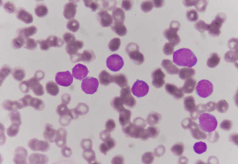 Leucemia de células pilosas: causas, síntomas y tratamiento