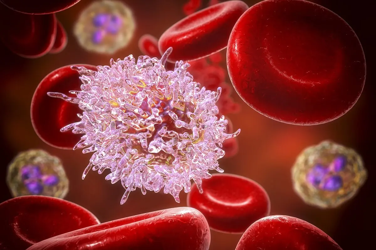 Leucemia de células pilosas