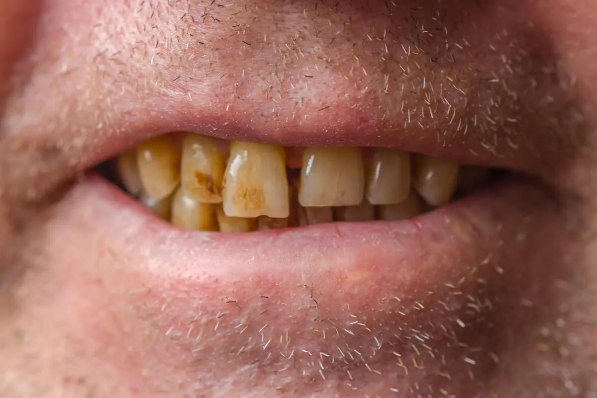 Manchas en los dientes de un fumador.