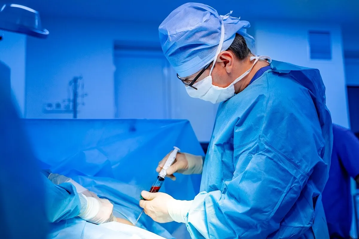 Biopsie de moelle osseuse pour macroglobulinémie de Waldenström.