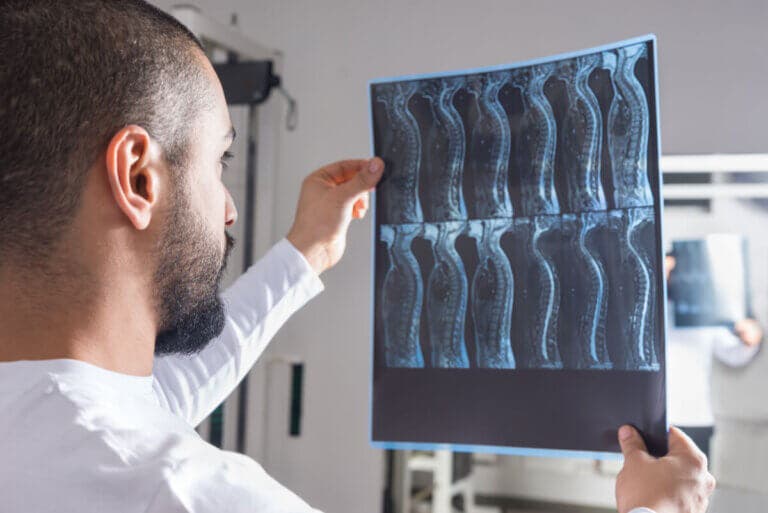 Siringomielia: causas, síntomas y complicaciones