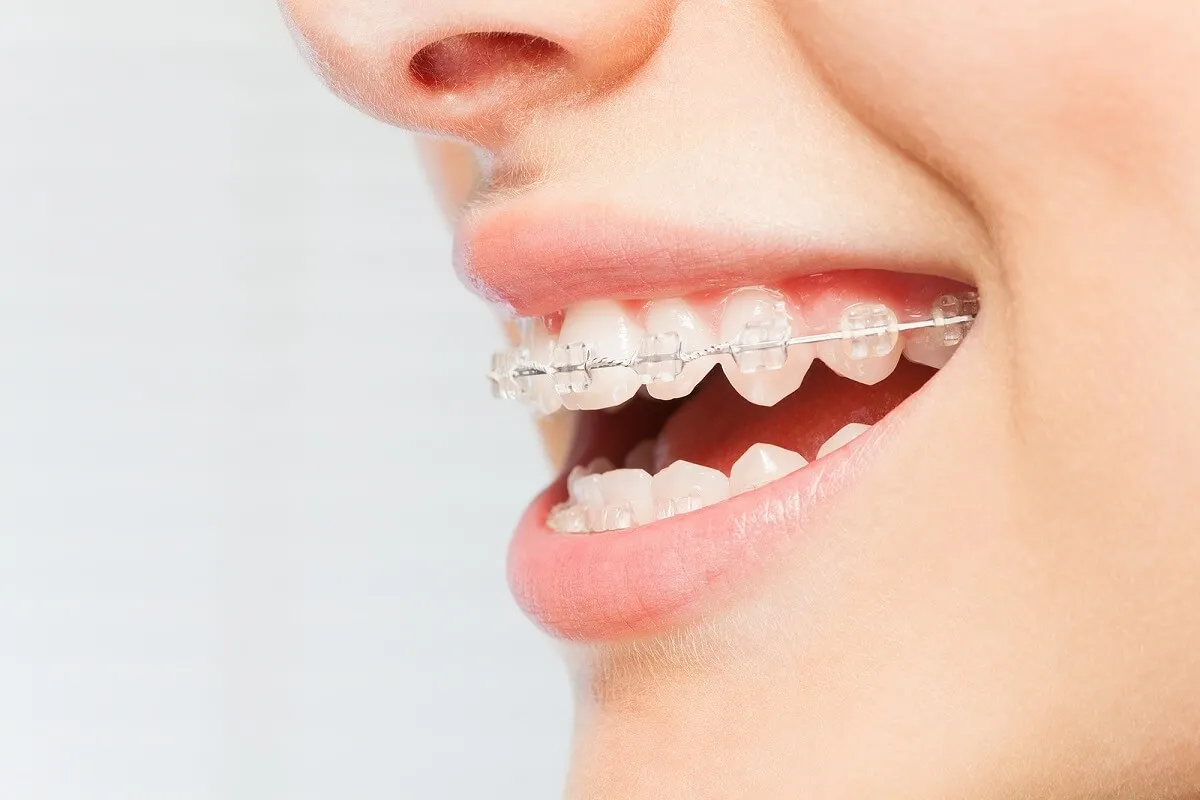 ¿Qué son los brackets de cerámica?