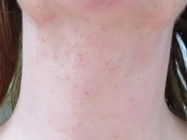 ¿Qué son las petequias y qué las causa?