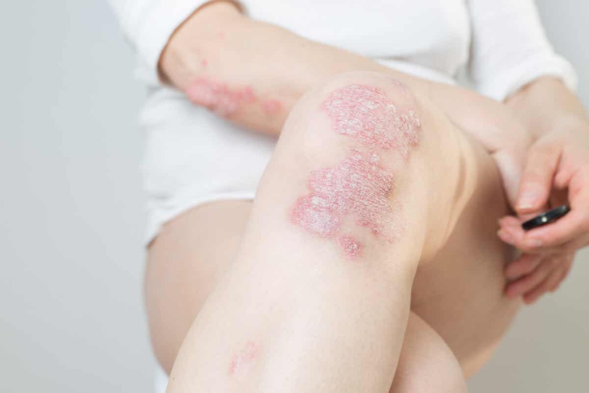 La inflamación de la piel de la psoriasis provoca acumulación de células en la epidermis.