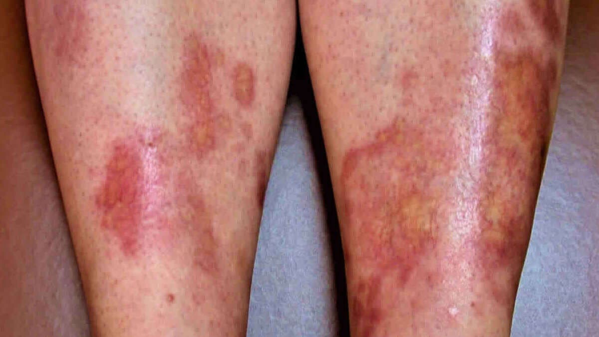Necrobiosis lipodica.