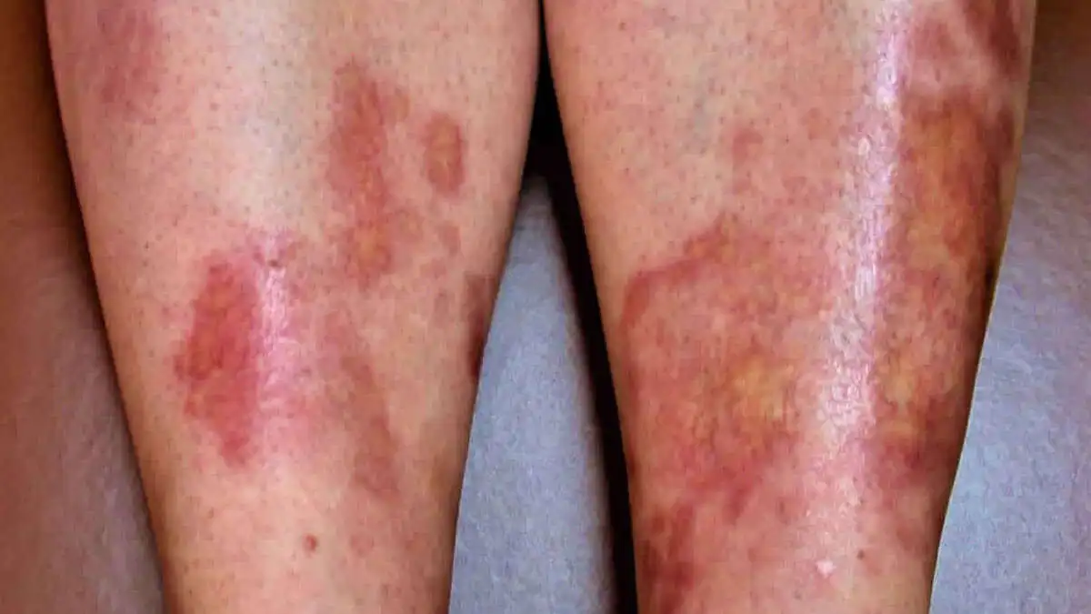 Necrobiosis lipodica.