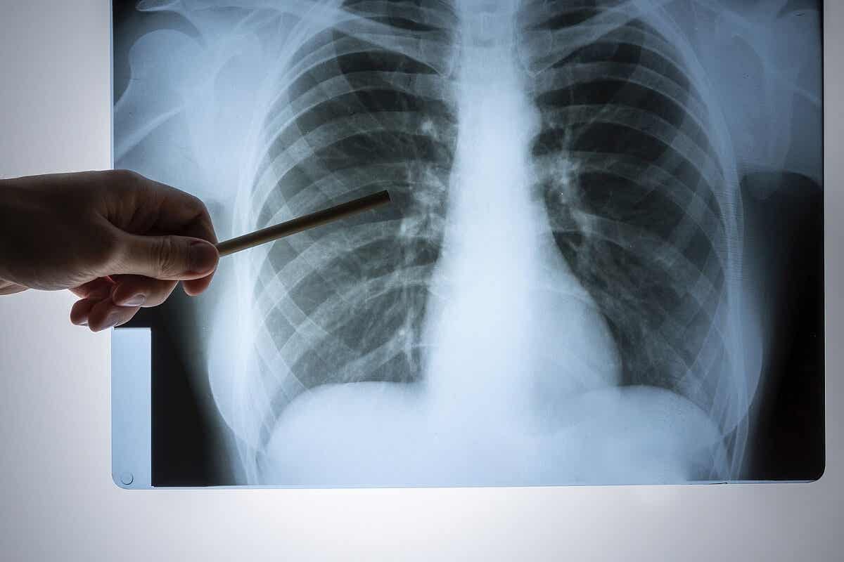 Radiografía para diagnosticar dolor en el lado derecho del pecho.