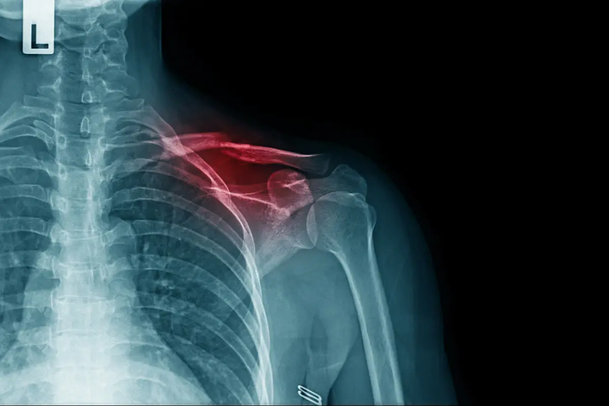 Radiografía de una fractura de clavícula.