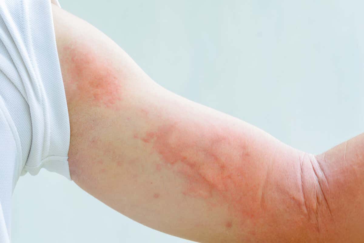 El eczema y estrés son enfermedades relacionadas.
