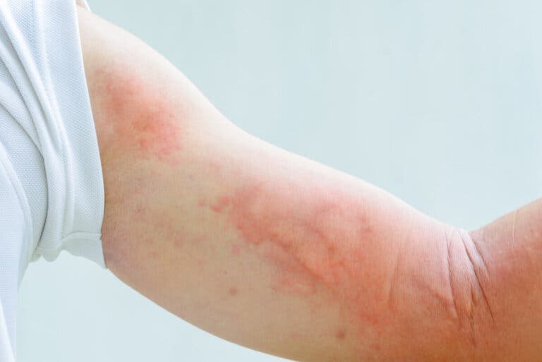 Urticaria colinérgica: ¿en qué consiste?
