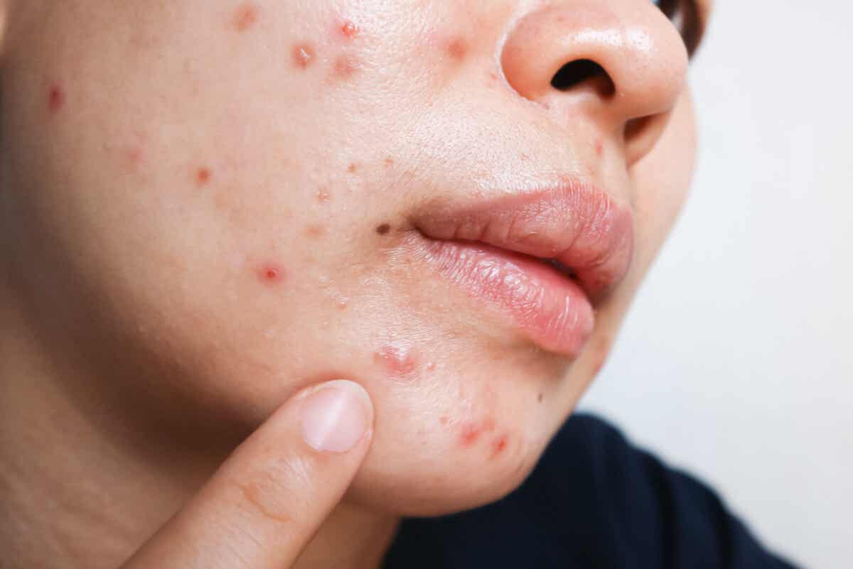Pickel oder Fieberbläschen? Gesicht mit Akne