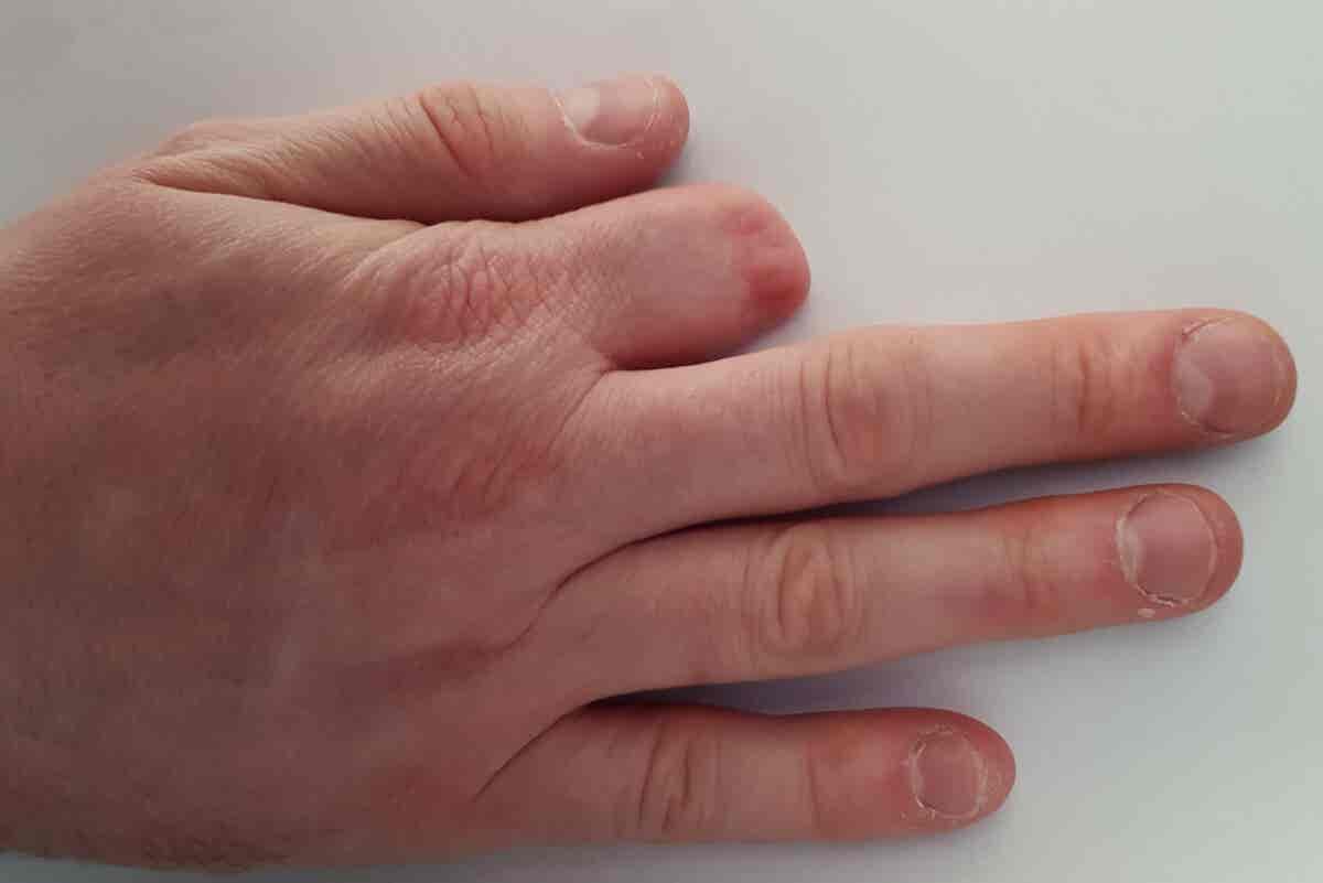 Mano con dedo amputado.