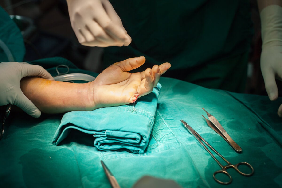 Cirugía para la amputación accidental de un dedo.