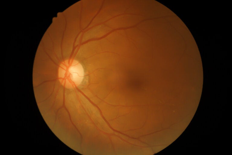 Oclusión de la arteria retiniana: ¿qué es y por qué ocurre?